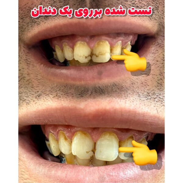 خرید جرمگیر و سفید کننده دندان لاورا (LAVERA) از بارین شاپ