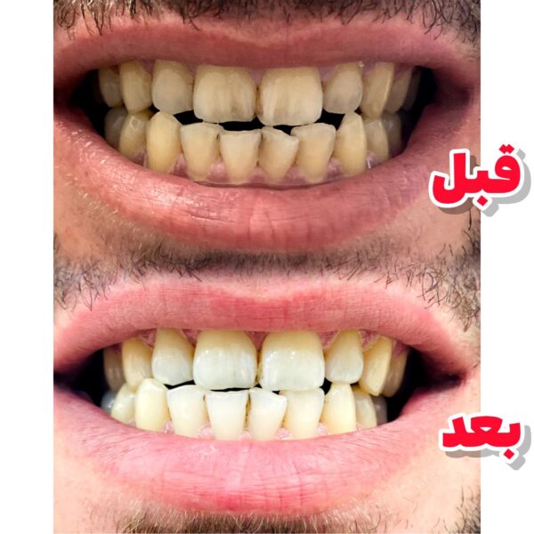 جرمگیر و سفید کننده دندان لاورا (LAVERA)